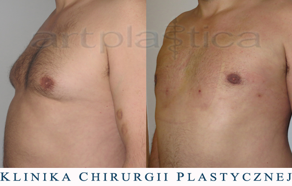 Ginekomastia - zdjęcie przed i 1 dzień po zabiegu liposukcji (widoczne miejsca wkłucia kaniulą)