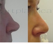 Operacja plastyczna - korekta nosa - zdjęcie przed i po operacji