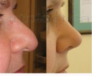 Operacja plastyczna - korekta nosa - zdjęcie przed i po operacji