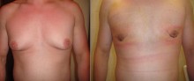 Ginekomastia - przerost gruczołu - redukcja piersi - zdjęcia przed i kilka dni po operacji