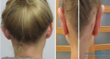 Zdjęcia przed i po zabiegu korekcji odstających uszu
