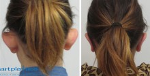 Zdjęcia przed i po zabiegu korekcji odstających uszu
