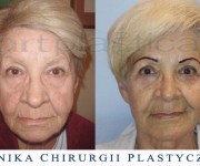 Beauty Group - Artplastica - lifting twarzy oraz plastyka powiek górnych i dolnych. Zdjęcie przed i po operacji.