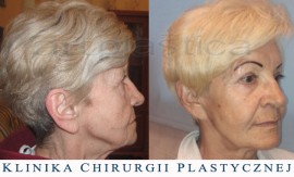 Beauty Group - Artplastica - lifting twarzy oraz plastyka powiek górnych. Zdjęcie przed i po operacji.