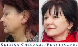 Beauty Group - Artplastica - lifting twarzy i szyi oraz plastyka powiek górnych. Zdjęcie przed i po operacji.