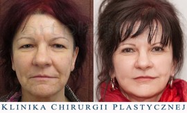 Beauty Group - Artplastica - lifting twarzy i szyi oraz plastyka powiek górnych. Zdjęcie przed i po operacji.