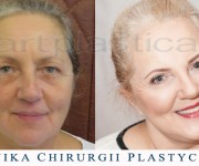 Beauty Group - Artplastica - lifting twarzy oraz plastyka powiek górnych. Zdjęcie przed i po operacji.