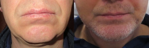 BG Artplastica_implant bródki_przed i po