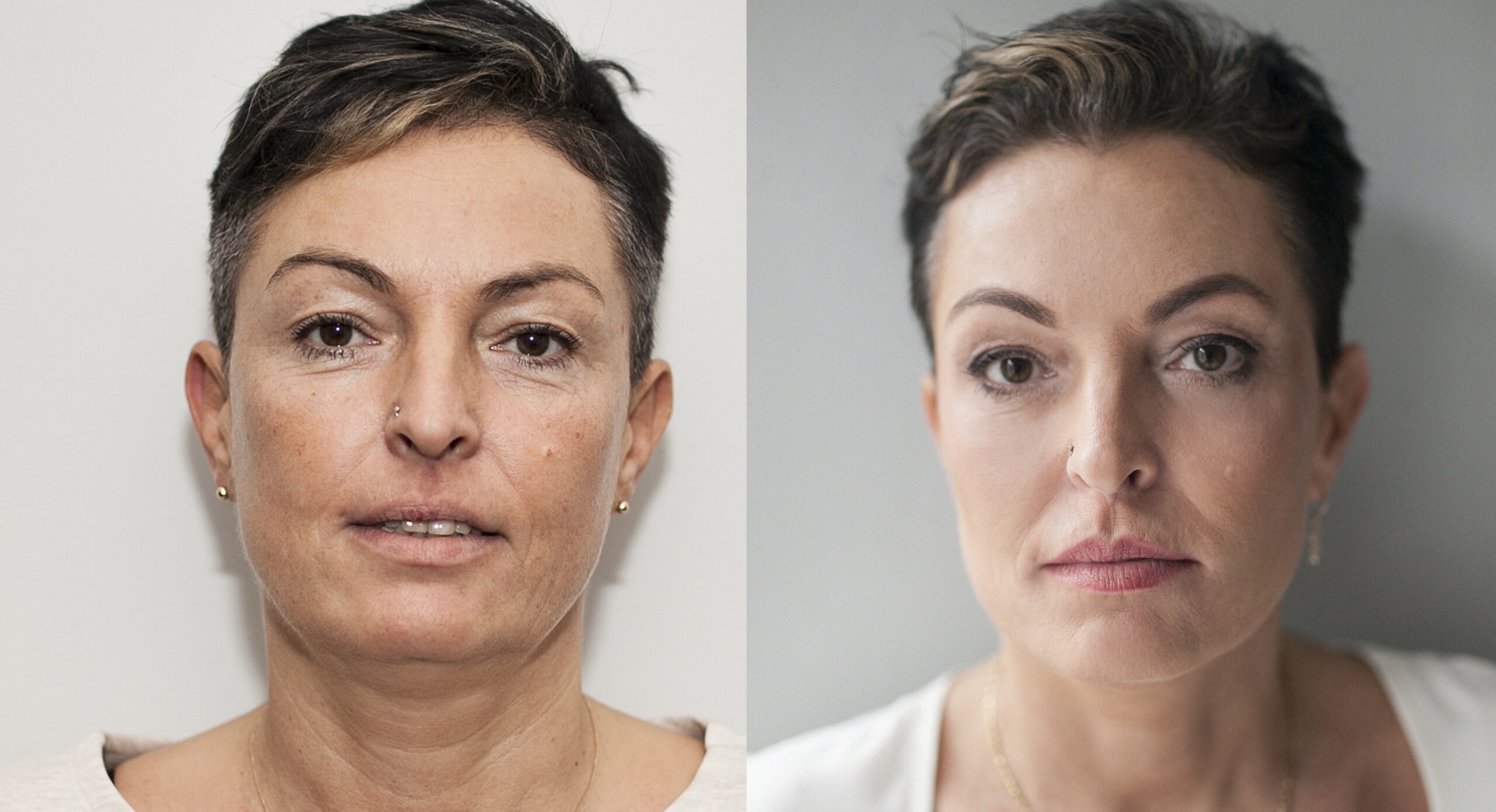 Efekty po wykonaniu zabiegów z użyciem preparatów Juvederm