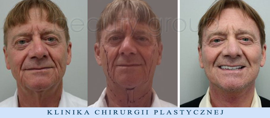 Augusto Moschini – lifting twarzy i szyi