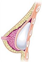 Powiększanie piersi - umiejscowienie implantu pod mięśniem