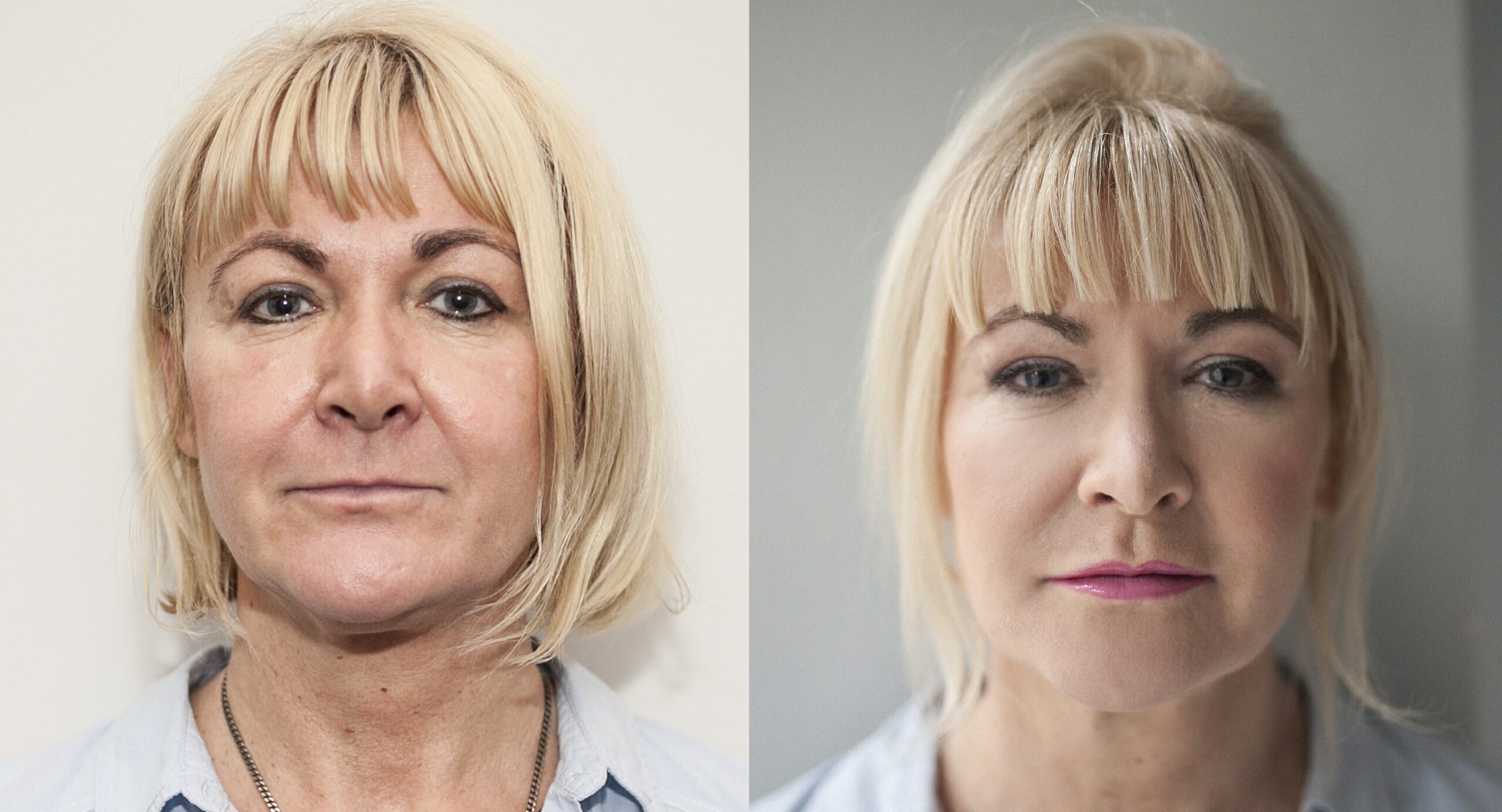 Efekty po wykonaniu zabiegów z użyciem preparatów Juvederm