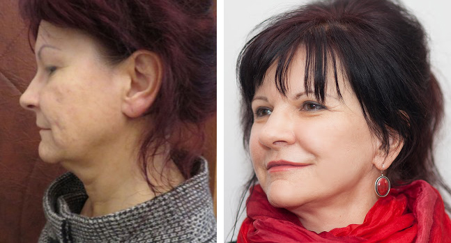 Lifting twarzy i szyi oraz plastyka powiek górnych. Zdjęcie przed i po operacji.
