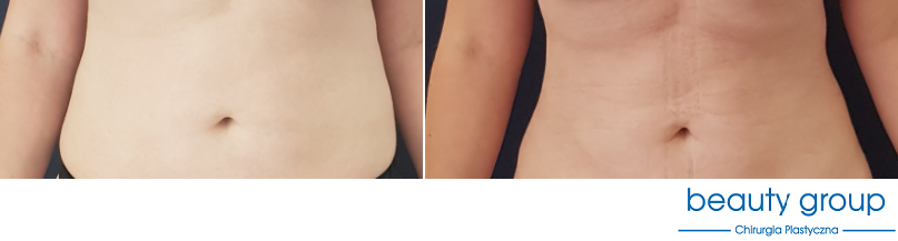 liposukcja