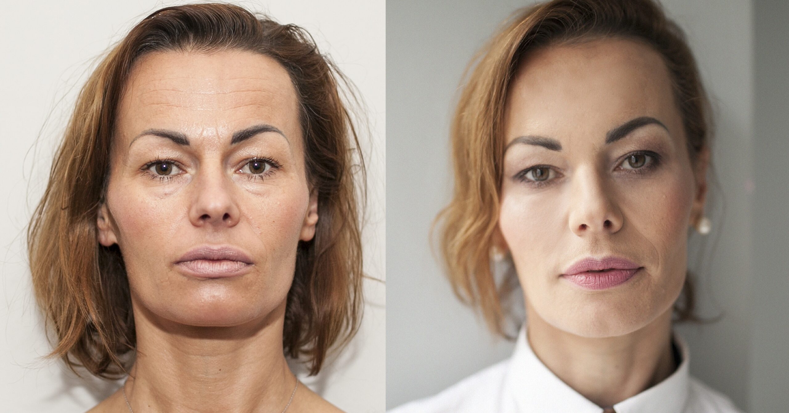 Efekty po wykonaniu zabiegów z użyciem preparatów Juvederm